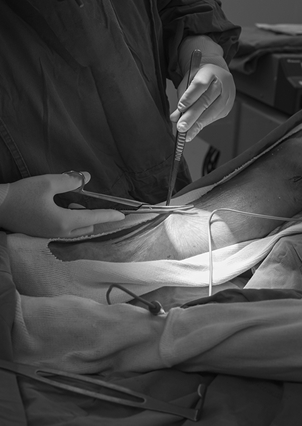Cirurgia de safena a laser