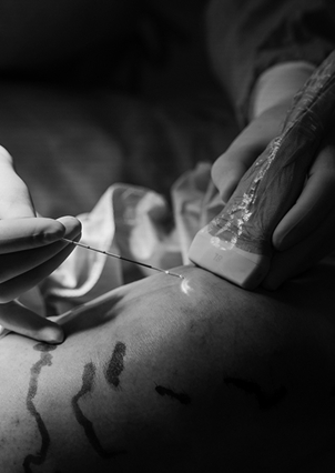 Microcirurgia de varizes
