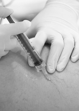 Escleroterapia